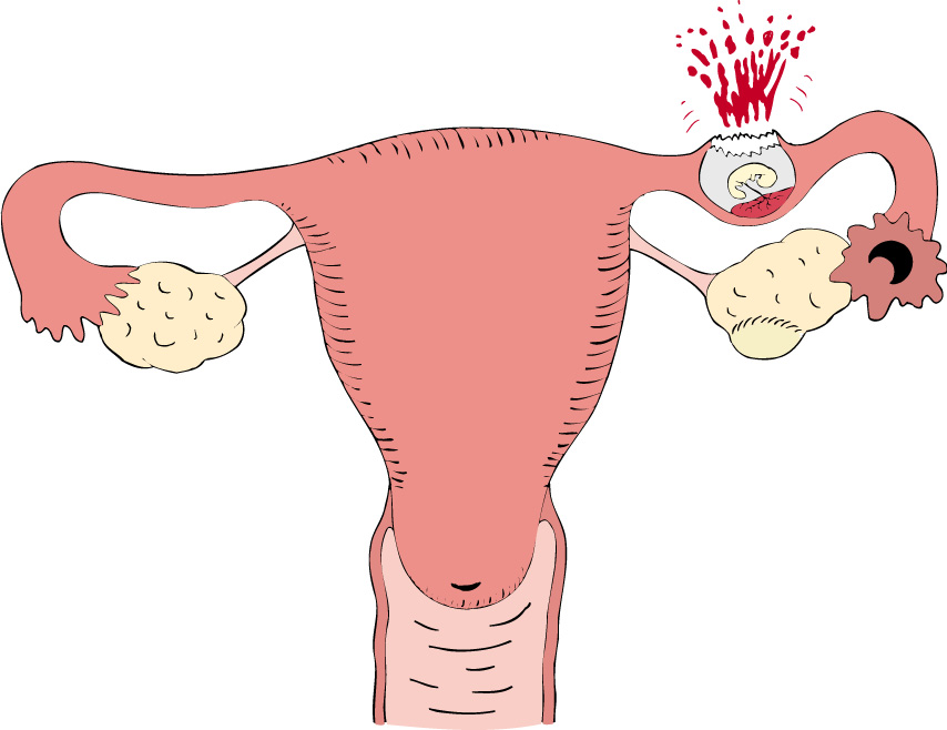прогестерон и внематочная беременность